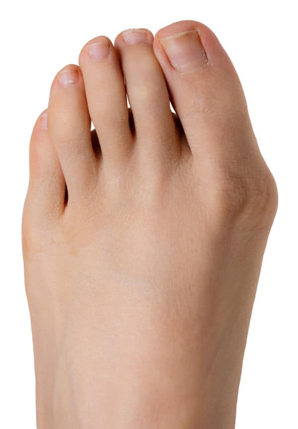 Mild Bunion