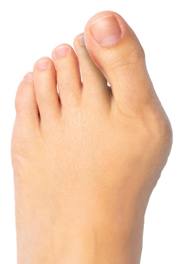 Moderate Bunion
