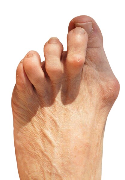 Severe Bunion